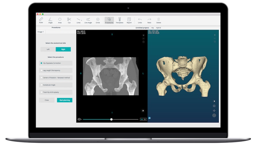 PeekMed vai introduzir o seu sistema ortopédico 3D nos EUA